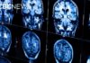 Revolutionary Medical Guideline Shakes Up Heart-Brain Care New guidelines urge doctors to treat heart and brain health