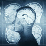 Slash Dementia Risk With These FREE Habits MRI scans of the brain displayed alongside a silhouette of a human head