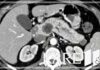 Mayo Clinic using AI to detect pancreatic cancer years before