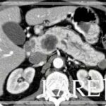 AI Predicts Cancer in Routine Scans Mayo Clinic using AI to detect pancreatic cancer years before