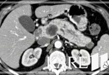 Mayo Clinic using AI to detect pancreatic cancer years before