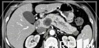 Mayo Clinic using AI to detect pancreatic cancer years before