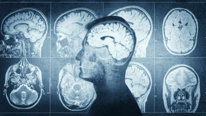 shutterstock_1942537936 MRI scans of the brain displayed alongside a silhouette of a human head