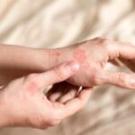 Close-up of a person's hands showing skin irritation and redness