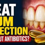 Severe Gum Disease: Fish Oil vs Antibiotics