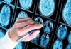 MRI Exposes Silent Brain Aging – Decades Early Hand with pen pointing at brain MRI scans