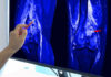 A hand pointing at an MRI scan of a knee joint on a monitor