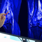 Bone Loss Starts Shockingly Early A hand pointing at an MRI scan of a knee joint on a monitor