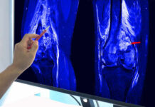 A hand pointing at an MRI scan of a knee joint on a monitor