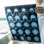 Alzheimer’s | Penn Doctors Stunned By Split-Damage Brain Doctor holding brain MRI scan film